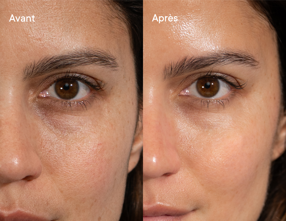 Targets Dark Circles at Their Source.