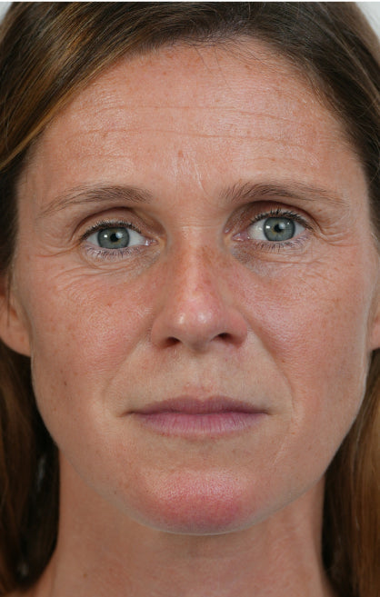 Before — Biopeeling Treatment