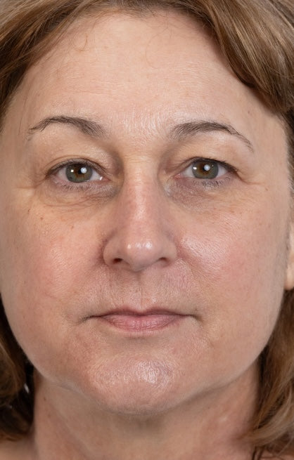 After — Longevity Booster Treatment