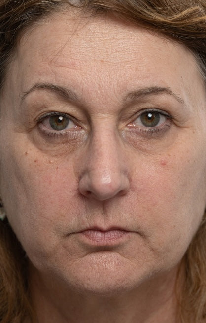 Before — Longevity Booster Treatment