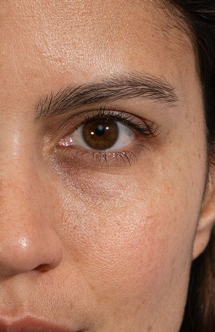 Before — Eye Area Treatment