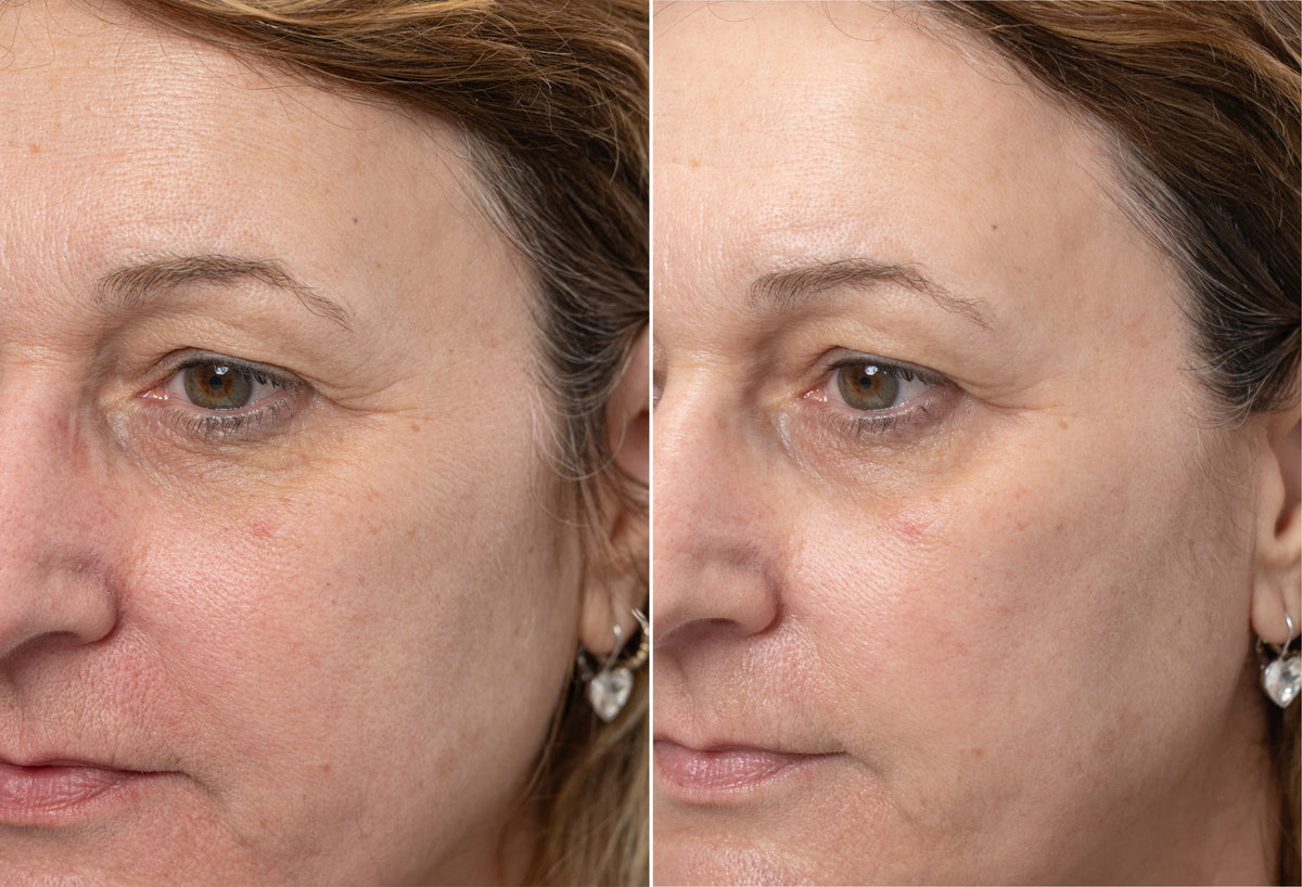 Targets Dark Circles at Their Source.